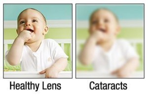 Symptoms of Cataract